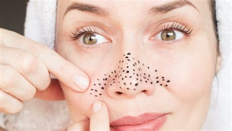 4 absolutely natural home remedies for blackheads to swear by healthshots