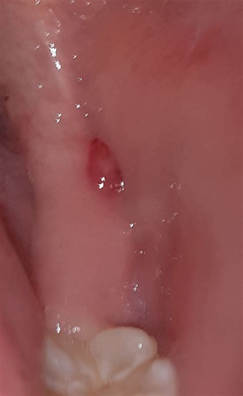 Tiny Bumps On Mouth Roof Red Spots On Roof Of Mouth C Vrogue Co