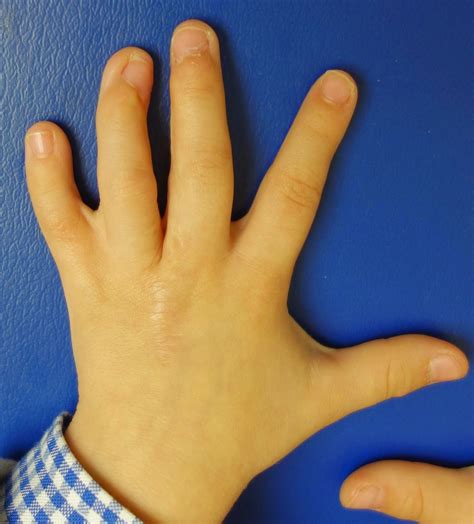 Syndactyly Outcomes And Challenges Congenital Hand And Arm
