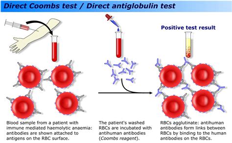 The dat is a serologic procedure that is used to detect in vivo binding of igg antibody and/or complement on the red cells the procedure involves washing the patient's red cells to remove residual plasma proteins and then testing the washed cells with antiglobulin reagent. Coombs Test : Types, Principle, Procedure and ...