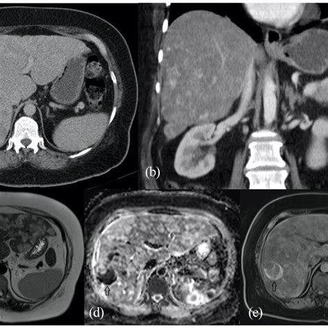 A Non Contrast Ct Abdomen Demonstrating Multiple Liver Lesions With