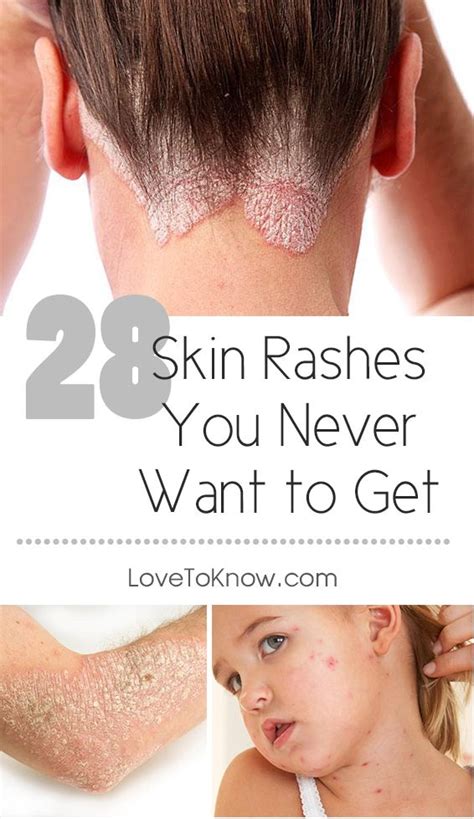 11 Best Ideas About Good To Know On Pinterest Skin Rash Pretoria And