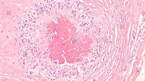 Photomicrograph Of A Rheumatoid Nodule A Firm Lump That May Develop