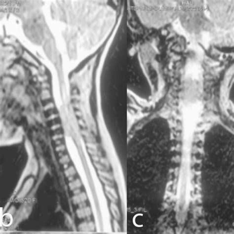 Preoperative MRI Of The Cervical Spine A Sagittal T Weighted Image B Download Scientific