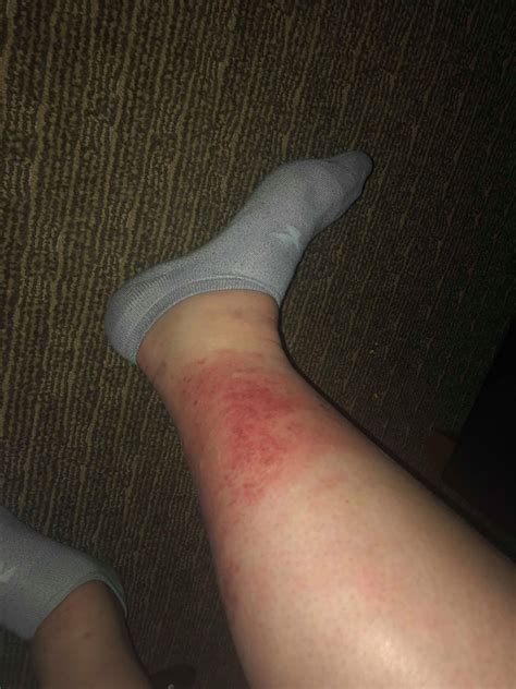 Indiana Woman Almost Loses Leg From ‘hot Tub Rash She Got While On