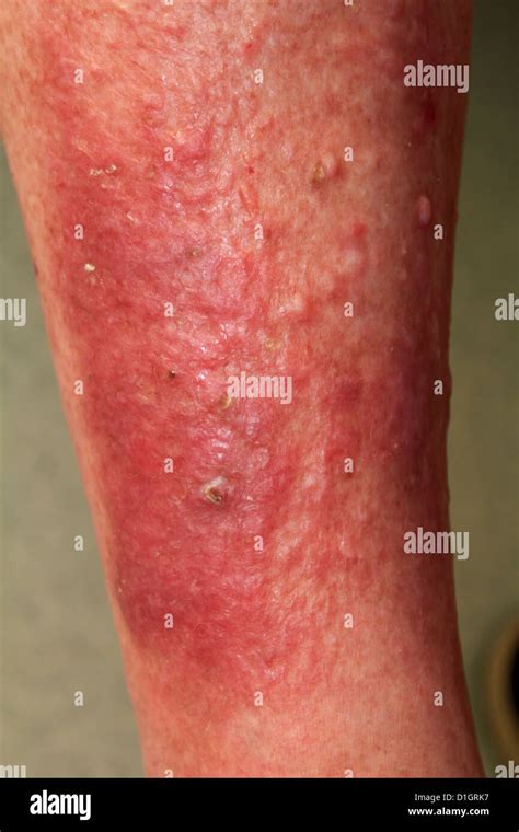 Atopik Dermatit Rahatlama