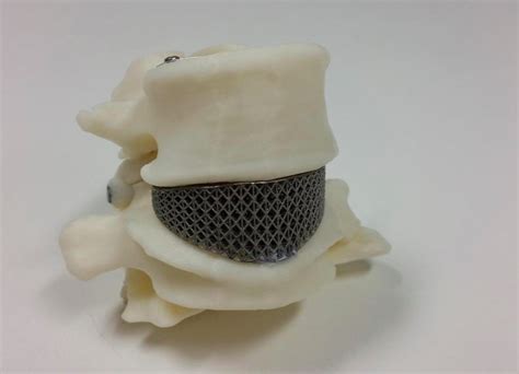 Australias First 3d Printed Spine Implant Ortho Spine News