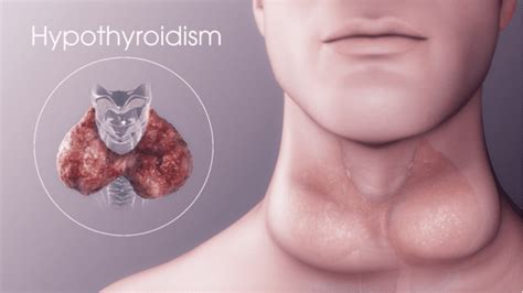 What Is Hypothyroidism And Is It Treatable Healthproadvice