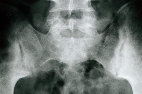Sacroiliac Joint X Ray Views