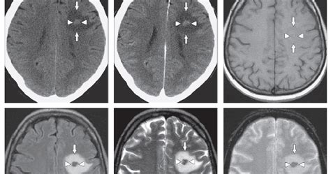 Malignant Brain Tumors Lifenurses