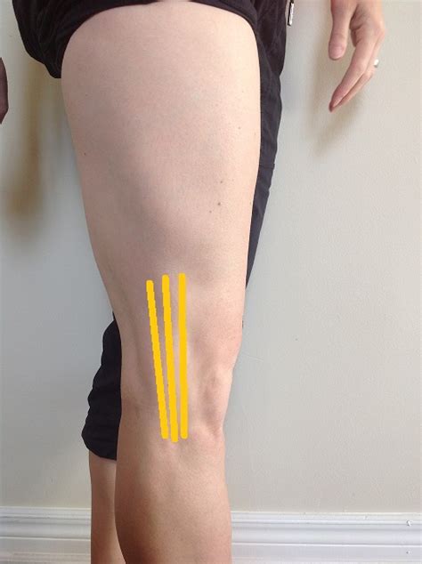 It Band Syndrome Running Injury Treatment In Burlington On
