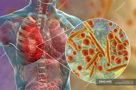 Pneumonia Caused By Mycoplasma Pneumoniae Bacteria Conceptual Digital