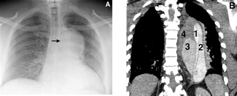 Complex Thoracic Aortic Dissection The Western Journal Of Emergency