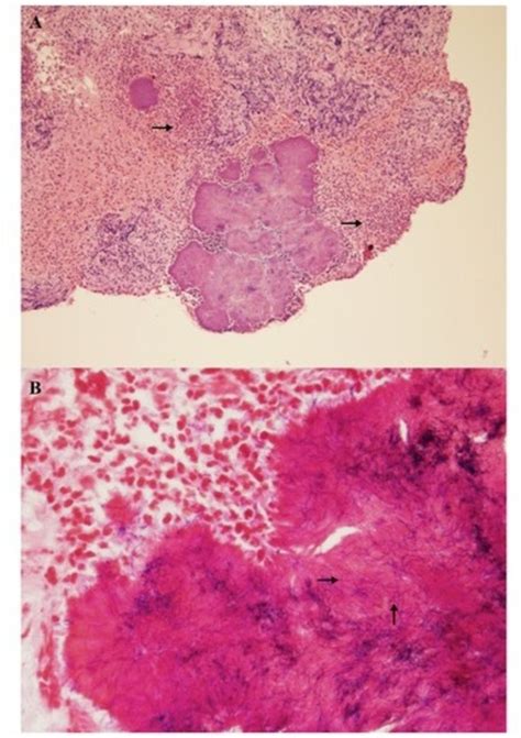 Actinomyces Cavernous Sinus Infection A Case And Systematic Literature