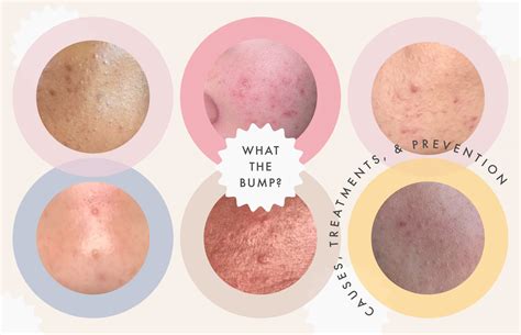 a complete guide to clearing the different types of clogged pores