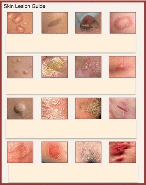 Dermatology Lesions Diagram Quizlet