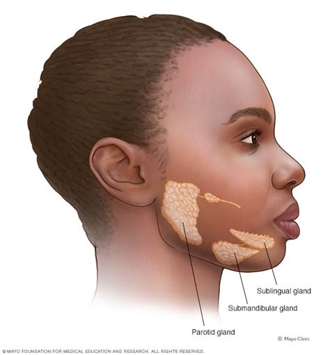 Mumps Symptoms And Causes Mayo Clinic