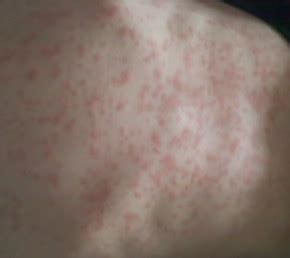 An amoxicillin rash is usually found therefore, use of amoxicillin drug may cause the rash. Amoxicillin Rash - Pictures, Treatment, Symptoms, Causes ...