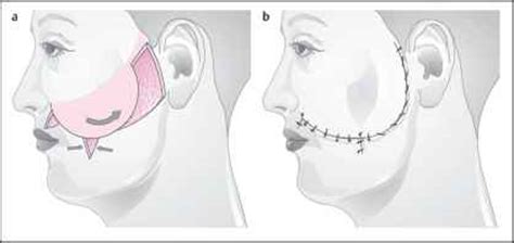 Opposing Transposition Flaps Facial Plastic Surgery