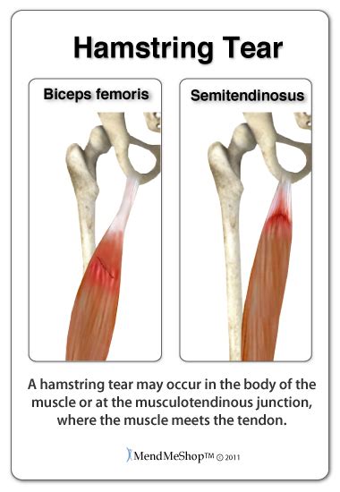 proximal hamstring tendon rupture