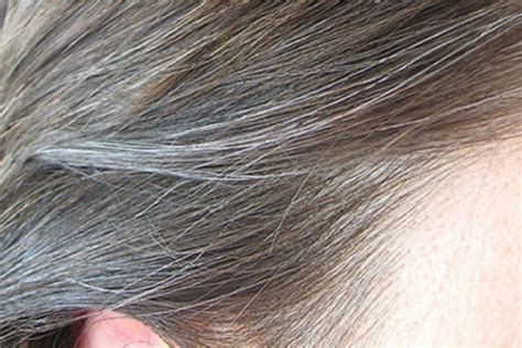 If your parents or grandparents had white or grey hair, then you are more likely to have it too. Premature greying white hair treatment in delhi, India