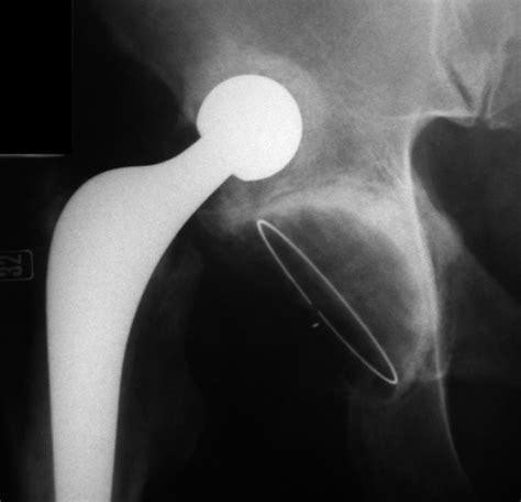 Figure 2chronic Asymptomatic Dislocation Of A Total Hip Replacement A