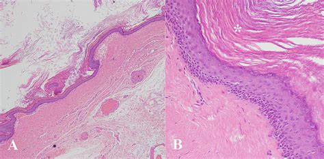 Cureus A Rare Case Of Presacral Epidermoid Cyst In An Adult Male