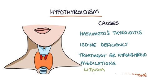 Hypothyroidism And Hashimoto S Thyroiditis Visual Explanation For