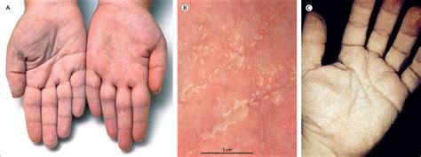 Aquagenic Wrinkling Of The Palms A Diagnostic Clue To Cystic Fibrosis