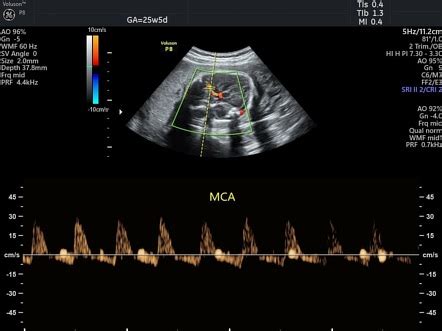 Fetal Middle Cerebral Arterial Doppler Assessment Radiology Reference