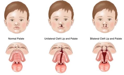 Cleft Lip And Cleft Palate Vikram Ent Hospital