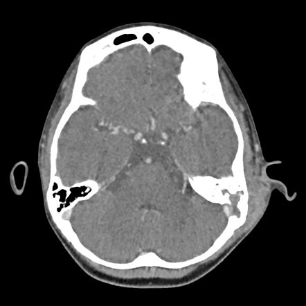 Subperiosteal Abscess Of The Mastoid Radiology Reference Article