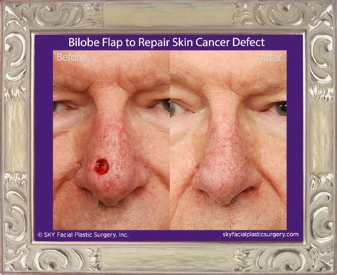 Mohs Reconstruction In San Diego After Skin Cancer — Sky Facial Plastic
