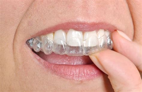 Braces In Denton And Krum Tx Cramer Orthodontics