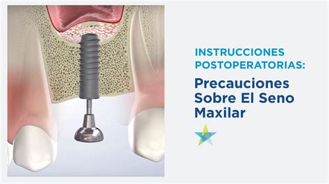 Instrucciones Postoperatorias Seno Park Cities Oral And Maxillofacial Surgery Associates Youtube