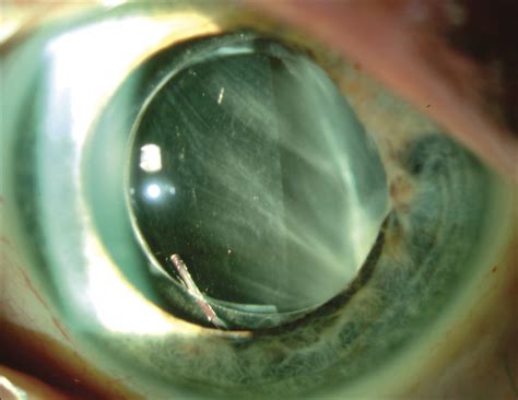 Vitreous china is an enamel coating that is applied to ceramics, particularly porcelain, after they've been fired, though the name can also refer to the finished piece as a whole. Vitreous Band Formation and the Sustained-Release ...