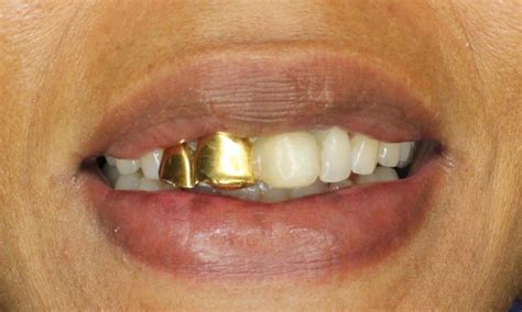 Where can i get gold teeth. Hopewell Family Dentistry's Smile Gallery | Replacing gold ...