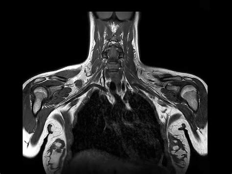 Non Invasive Nerve Plexus Imaging Philips Mr Body Map