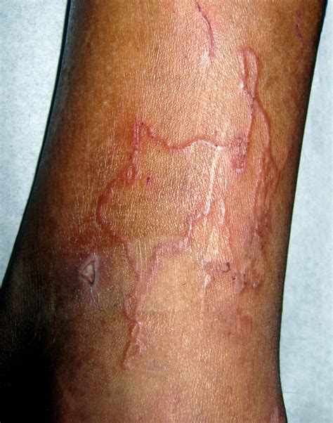 Human Hookworm Singapore Pdf Ppt Case Reports Symptoms Treatment