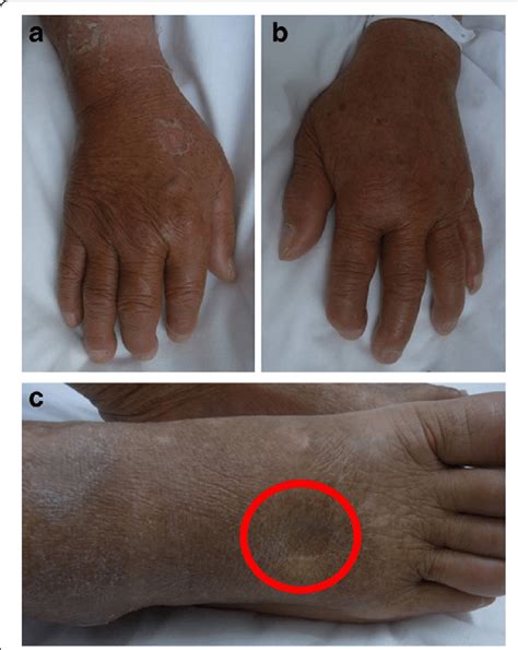 Pitting Edema Could Be Seen On The Patients Right Hand A Left Hand
