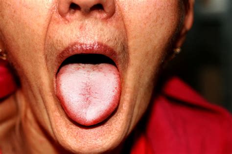 Najcz Stsze Choroby Jamy Ustnej Przyczyny I Leczenie Porady W Interia Pl