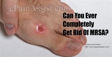 Can You Ever Completely Get Rid Of Mrsa