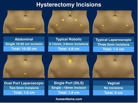 Simplified Vaginal Hysterectomy