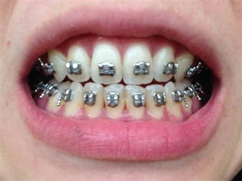State whether the following statements are verdadero or falso. dontdoubthappiness: Orthodontics ... braces braces braces