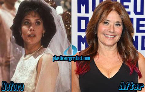 Lorraine Bracco Plastic Surgery Before And After Plastic