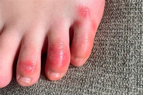 ‘covid Toes Other Rashes Are The Latest Rare But Possible Signs Of