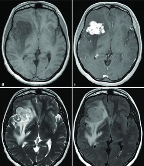 Brain Mri With And Without Contrast Demonstrated A 42 Cm Lobulated