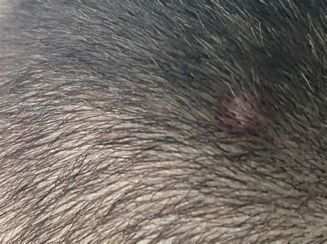 Pink Flesh Bump On Scalp Rdermatologyquestions