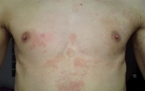 Hiv Rash Pictures Images Symptoms Causes And Treatment