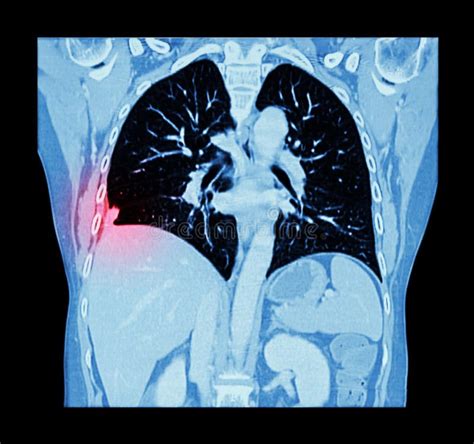 Lung Cancer Ct Scan Of Chest And Abdomen Show Right Lung Cancer